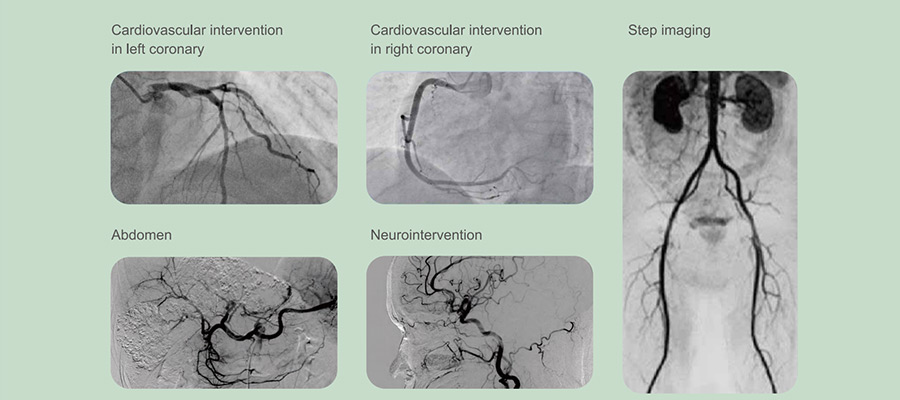 Vicor-CV SWIFT Digital Subtraction Angiography System