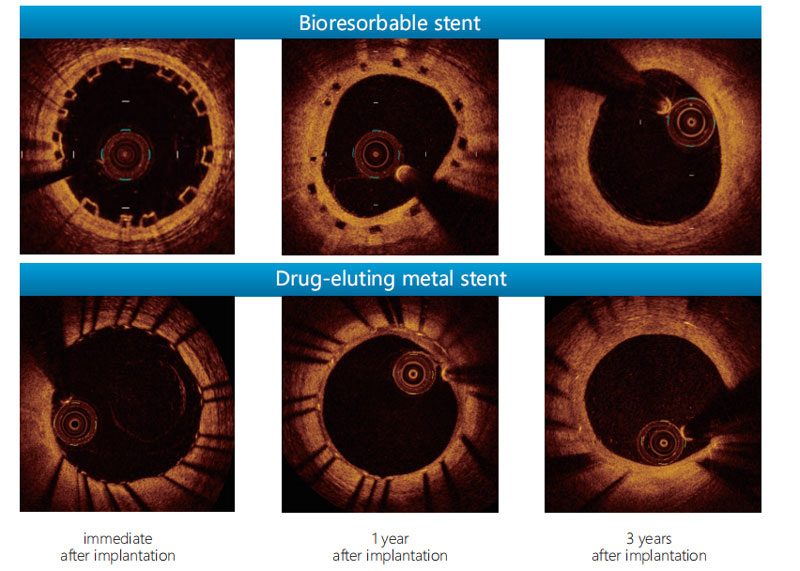 Absorbable Coronary Stents